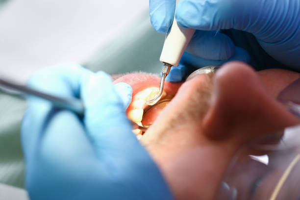 Best Emergency Wisdom Tooth Extraction in Kiryas Joel, NY
